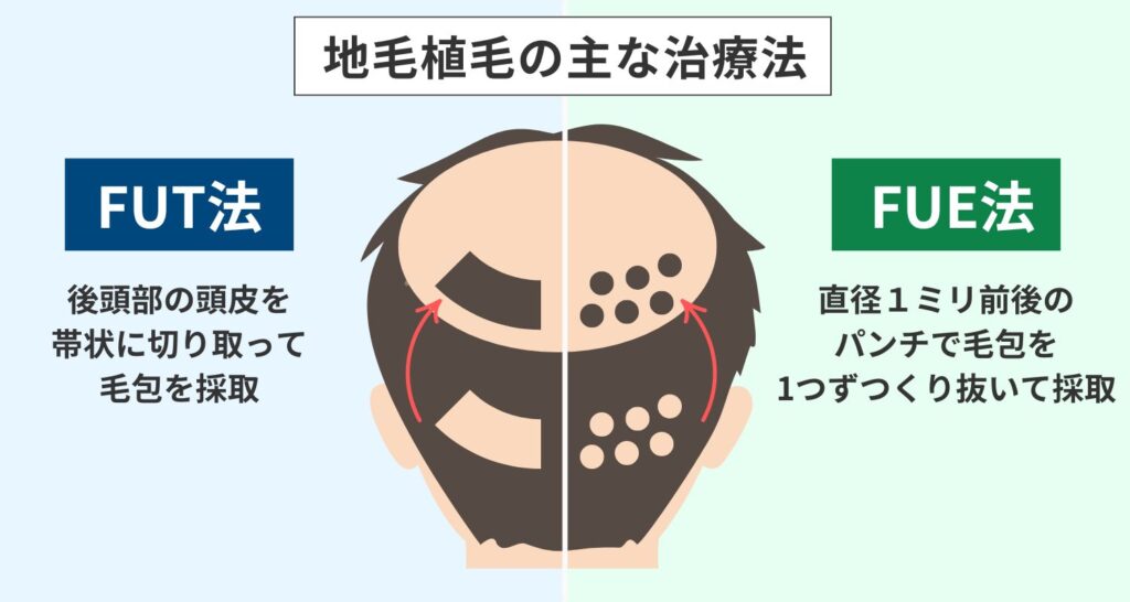 植毛におけるFUT法とFUE法の比較