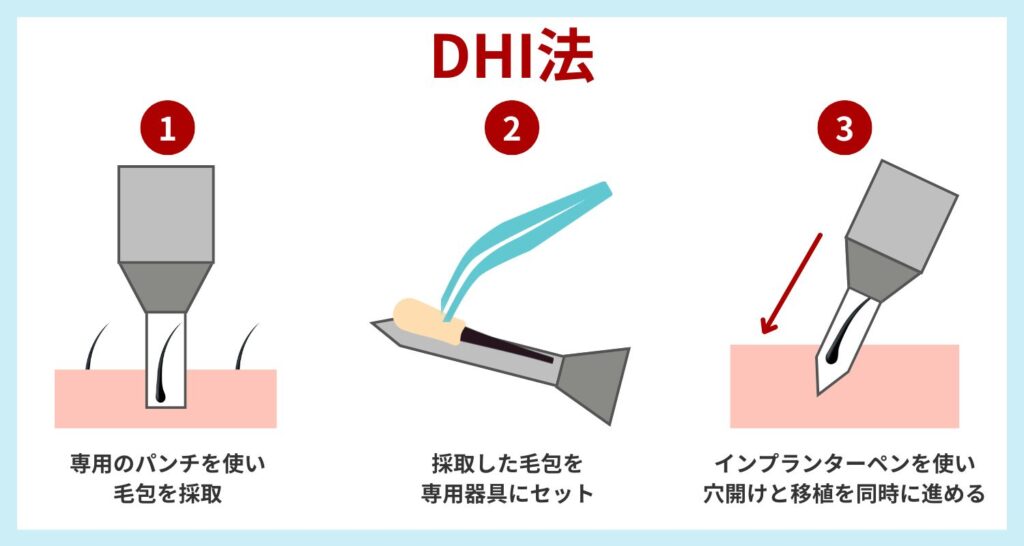 DHI法の特徴