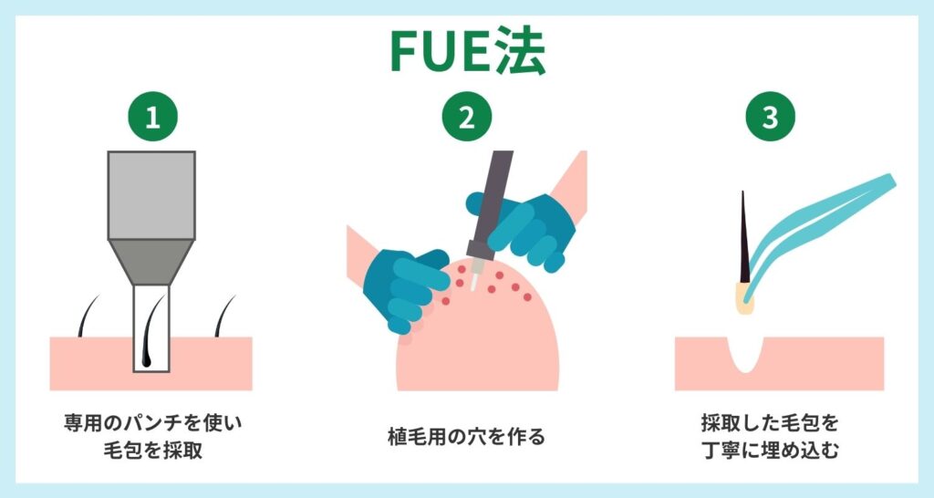 FUE法