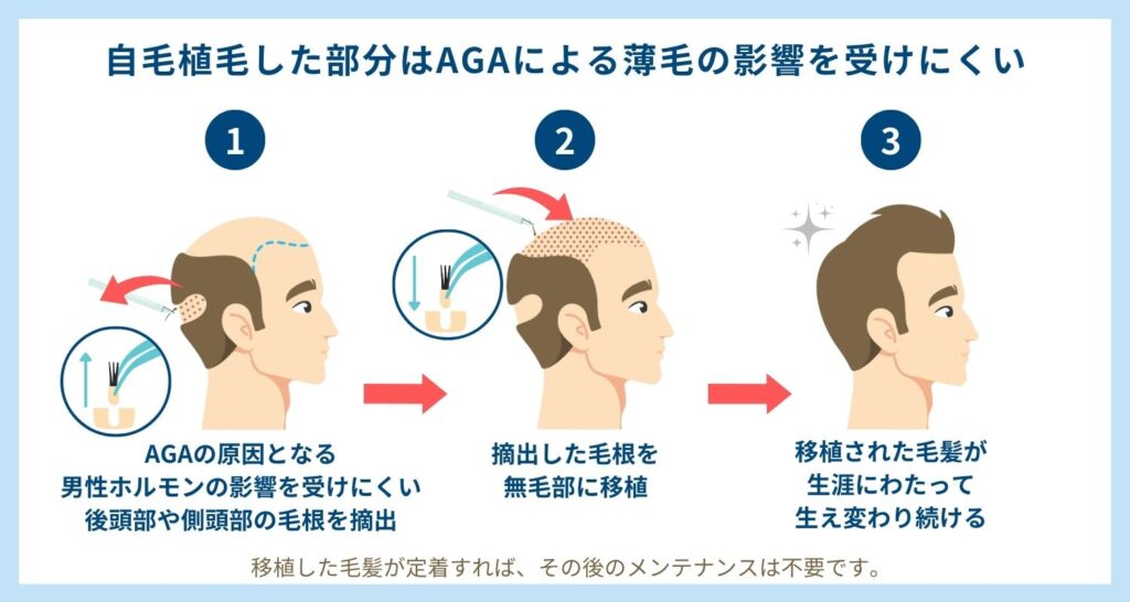 自毛植毛した部分はAGAによる薄毛の影響を受けにくい　